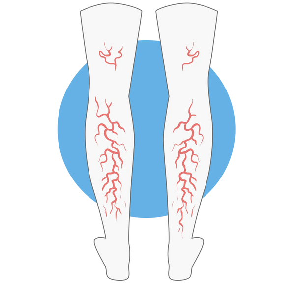 Venous Insufficiency
