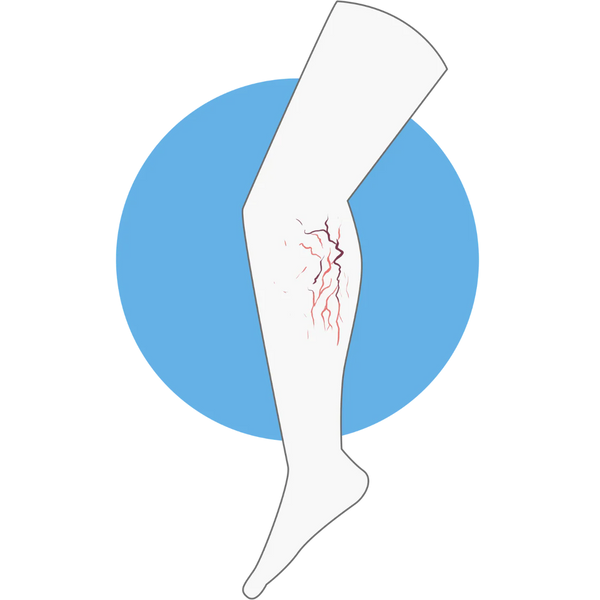 Varicose Veins