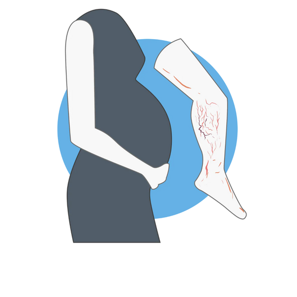 Edema During Pregnancy