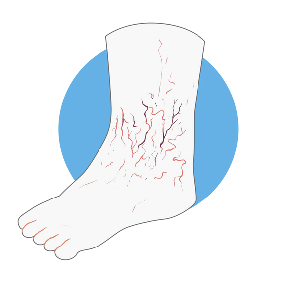 Diabetic Neuropathy