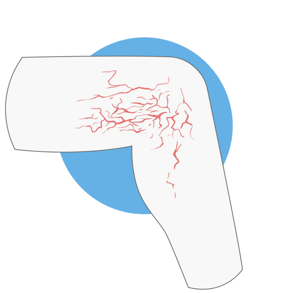 Thrombosis